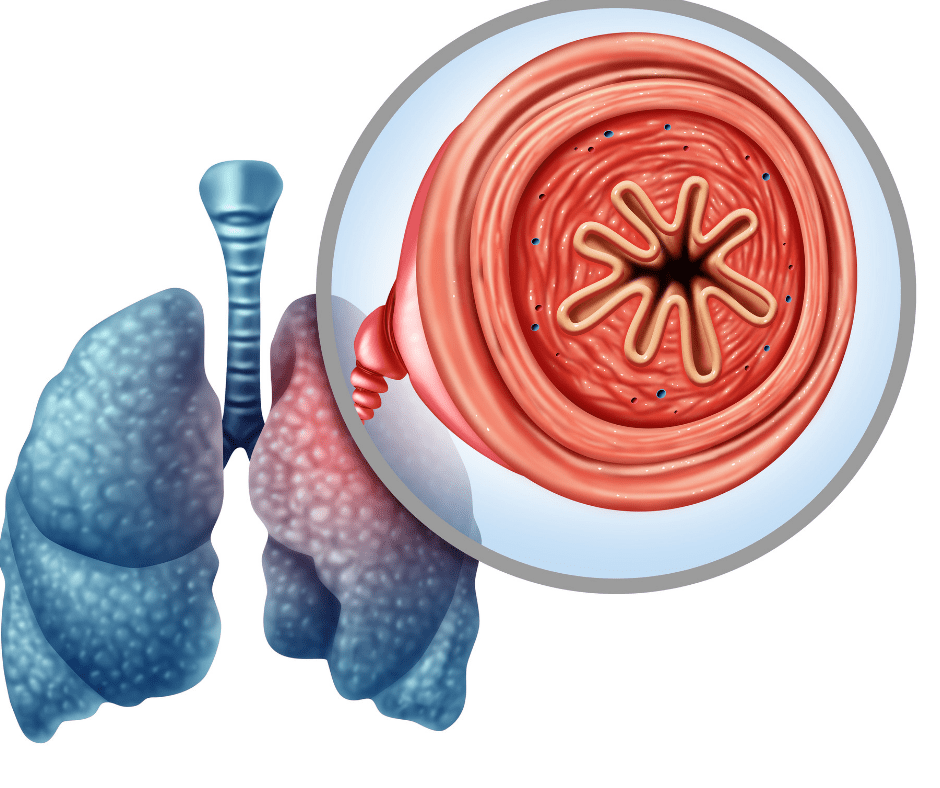 Asthma Symptoms, Diagnosis and Treatment with Advair Diskus and Advair
