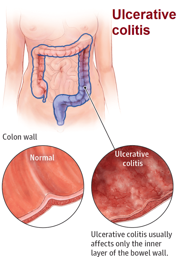 what-difference-between-uceris-extended-release-budesonide-and